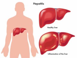 Hepatitis-A-B-C-D (1)
