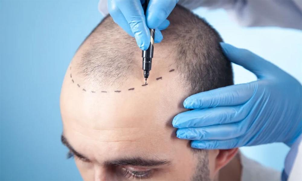 ചെറുപ്പക്കാരിലെ ഹെയർ ട്രാൻസ്പ്ലാന്റ്; ഈ കാര്യങ്ങൾ ശ്രദ്ധിച്ചില്ലെങ്കിൽ അപകടം