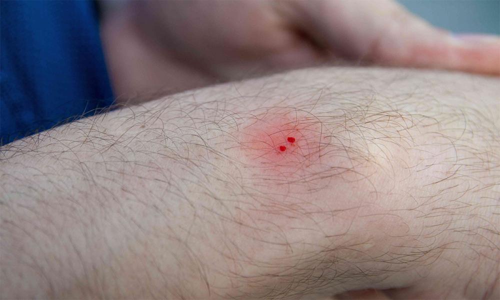 പാമ്പുകടിയേറ്റാൽ എങ്ങനെ തിരിച്ചറിയാം? ഈ ലക്ഷണങ്ങൾ അവഗണിക്കരുത്!